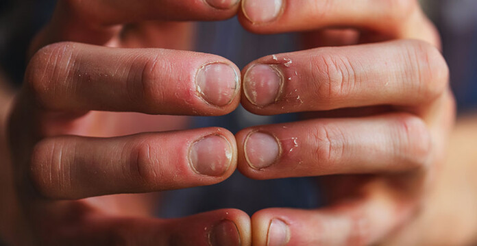 Male hands with extremely bitten nails, indicating anxiousness